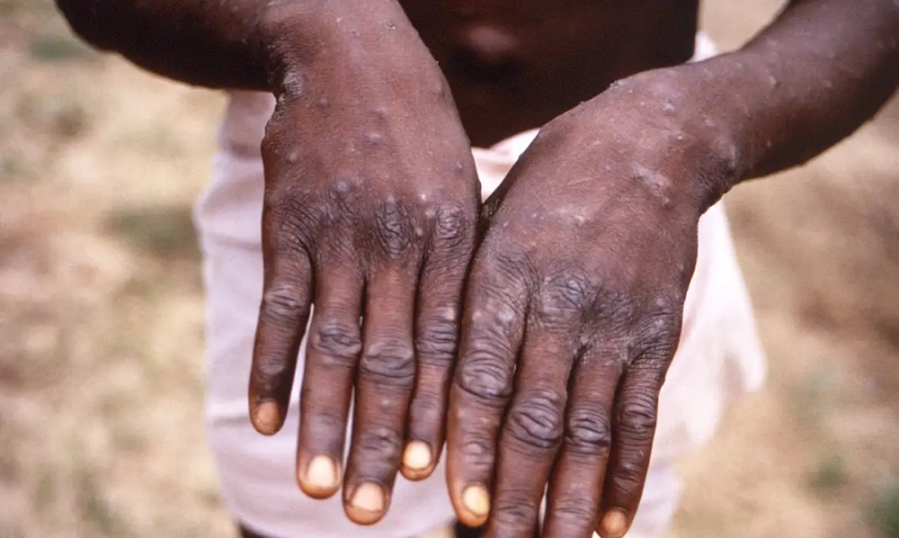 Ministério da Saúde envia equipe para monitorar caso de Mpox em São Paulo